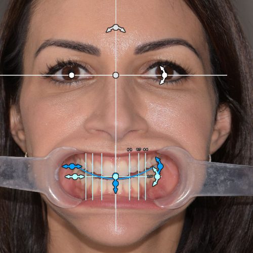 Digital Tooth Design
