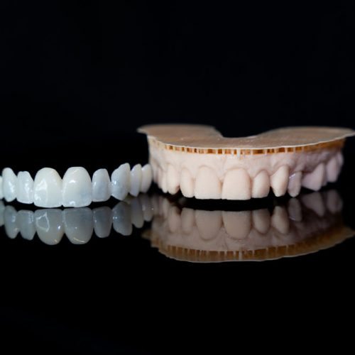 3D Printed Smile Trial Shells