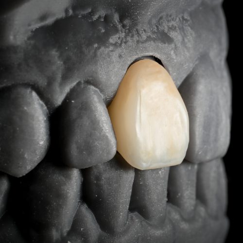3D Printed Restorations (Crowns/Bridges/Veneers/Inlays/Onlays)