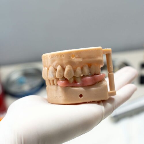 Temporary 3D Printed Denture