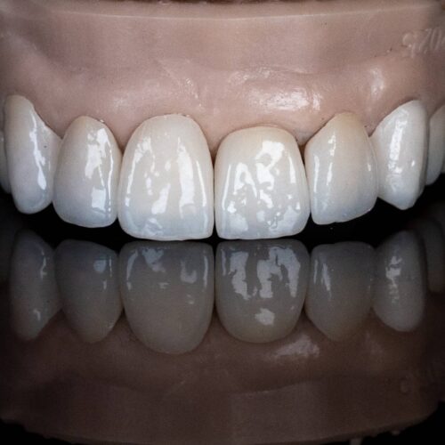 Porcelain Veneers