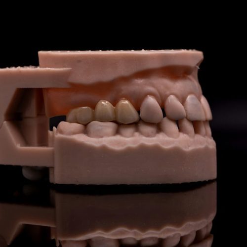 Porcelain Crown/ Bridge