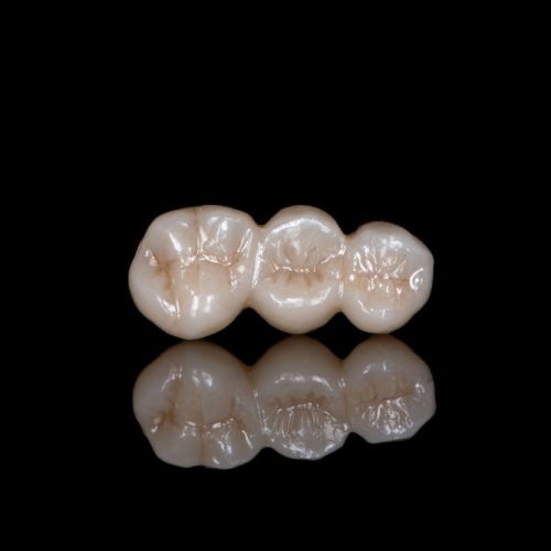 Porcelain Restoration (Crowns/Bridges/Veneers/Inlays/Onlays)