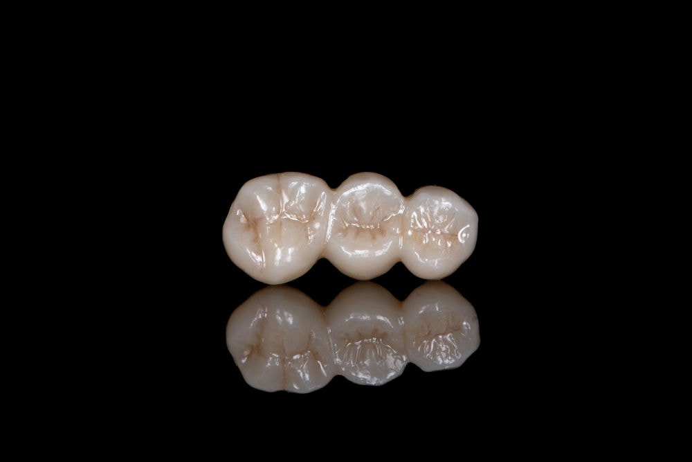 porcelien-crown-bridge-4